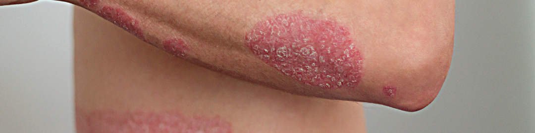 psoriase