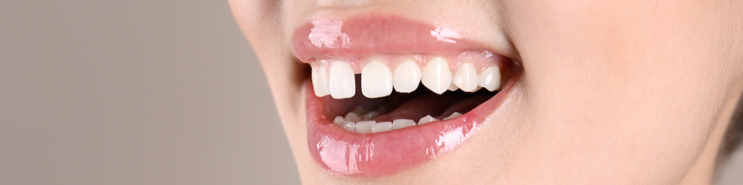 diastema 