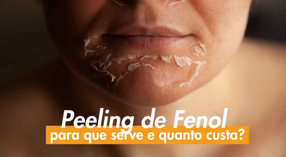 peeling de fenol