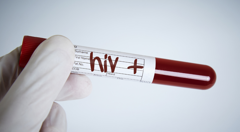 Nova variante do HIV